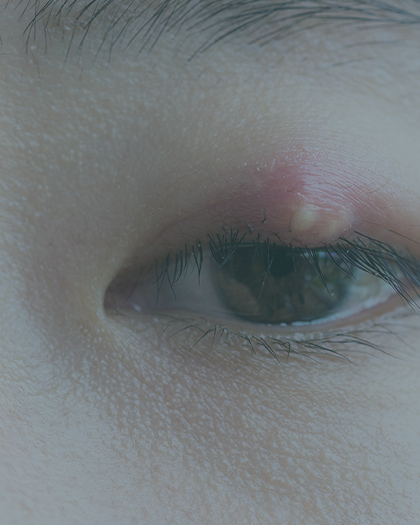 麦粒腫・霰粒腫 